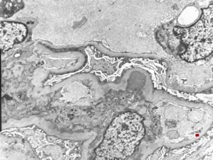 M,47y. | IgA nephropathy M,47y. | IgA nephropathy